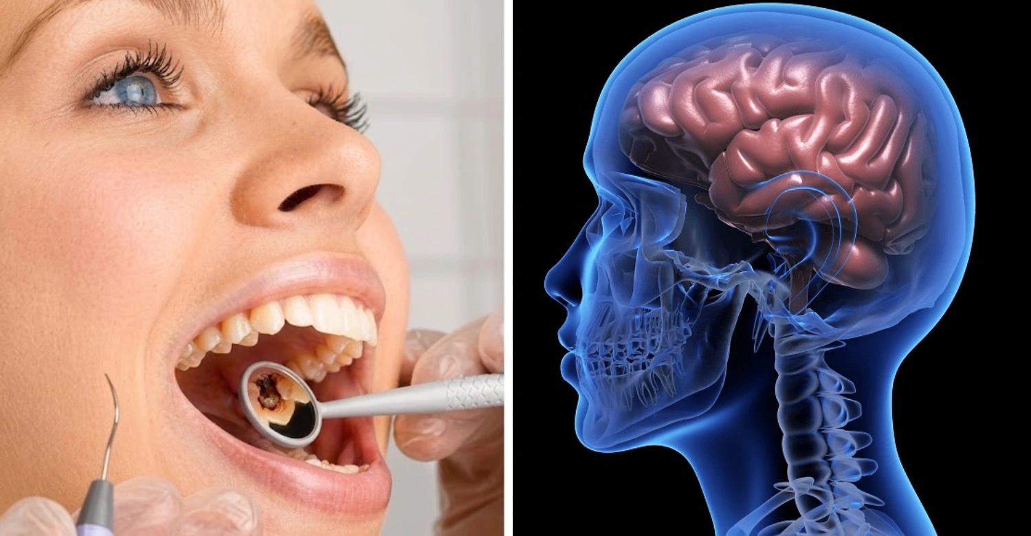Can Bad Teeth Cause Brain Problems Inblog